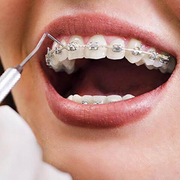 dental-braces-or-clips