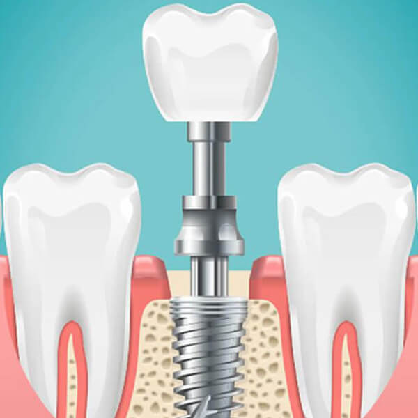 dental-implants