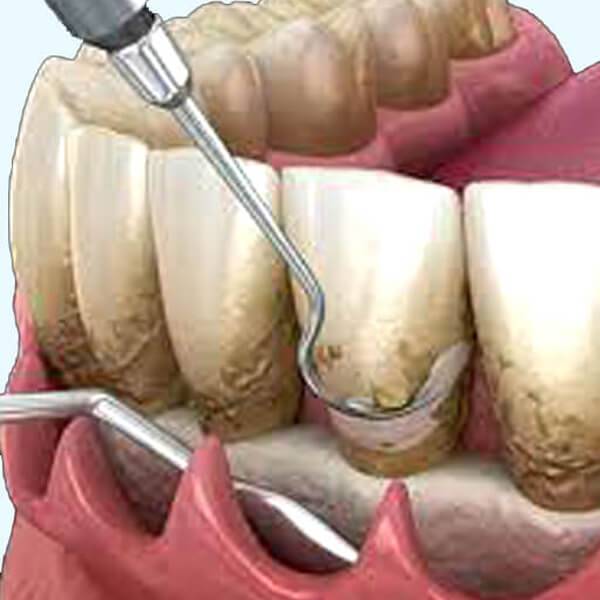 flap-surgery