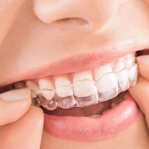 invisalign-aligners