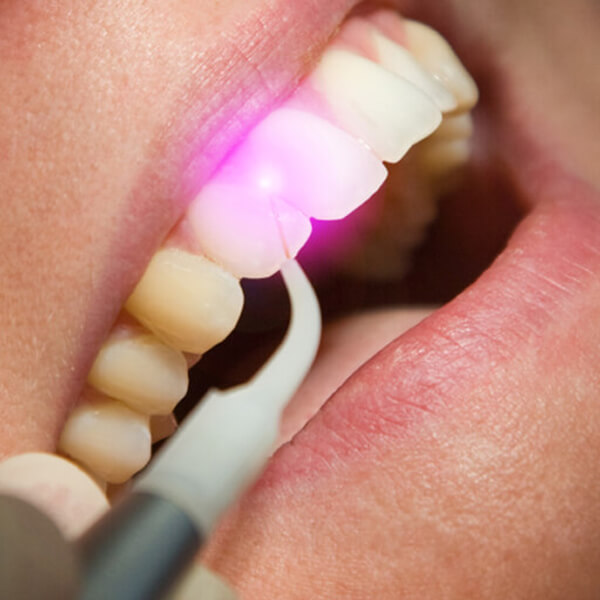 laser-gum-therapy