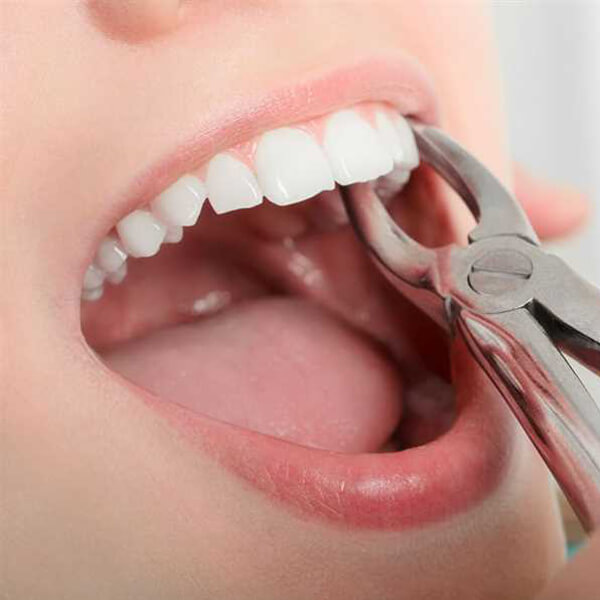 tooth-extraction