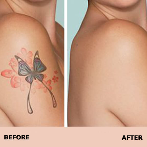 tattoo-removal